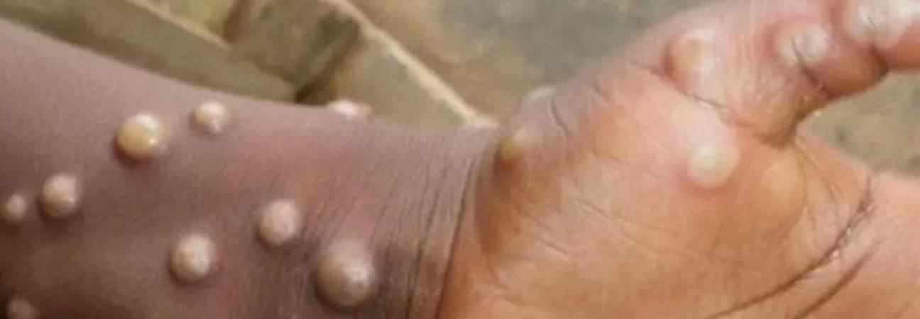 variole du singe oms alerte