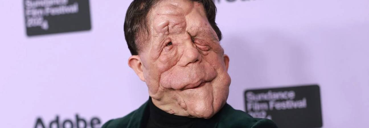 adam pearson neurofibromatose