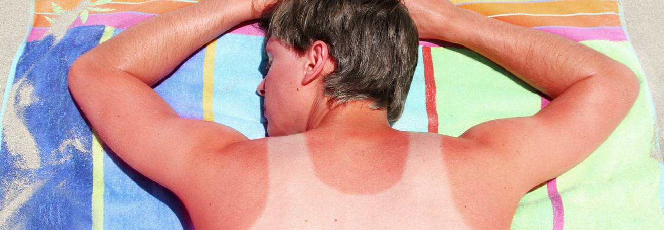 coup de soleil
